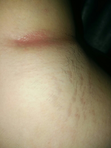 腋下有肿块疼痛是怎么回事 腋下有肿块疼痛是怎么回事