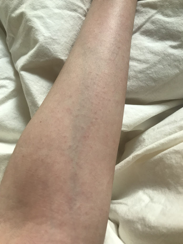 腋下体温37.2度怎么办 腋下体温37.2度怎么办