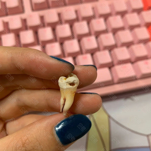 智齿痛的时候能拔吗 智齿痛的时候能拔吗