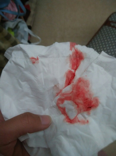 有点血性白带怎么回事 有点血性白带怎么回事