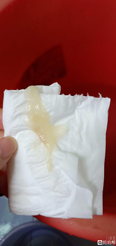 白带粘稠发黄像鼻涕 白带粘稠发黄像鼻涕