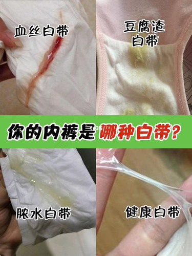 白带多怎么办才能解决 白带多怎么办才能解决