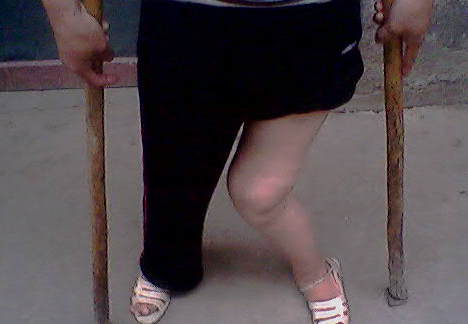 小儿麻痹症是什么病图片