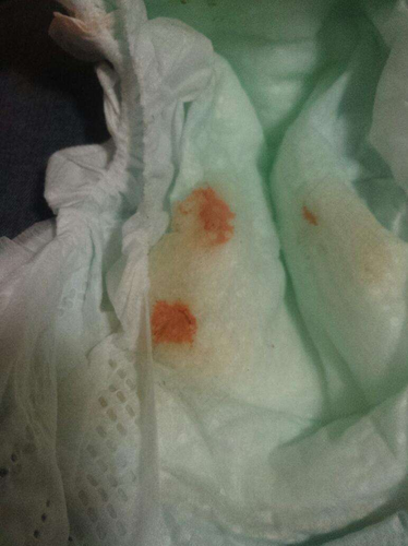 婴儿脐带干了不掉出血