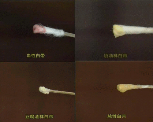 女性更年期分泌物增多是怎么回事 女性更年期分泌物增多是怎么回事