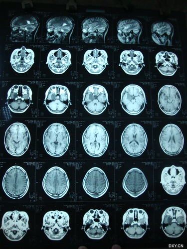 癜痫什么症状 癜痫什么症状