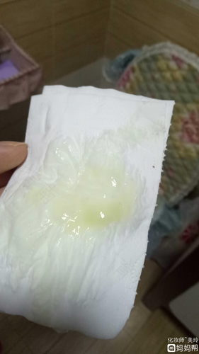 白带恶臭有血是怎么回事 白带恶臭有血是怎么回事