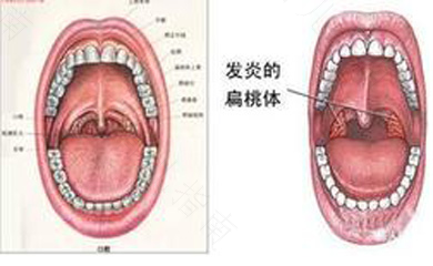 扁桃体炎是怎样引起的 扁桃体炎是怎样引起的