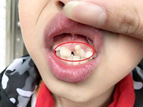 宝宝换牙期 父母注意7大问题