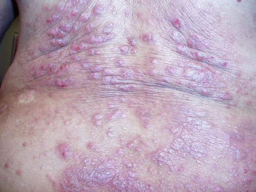 当阴道内有寄生虫感染时,就会对外阴造成刺激,从而出现外阴瘙痒症状