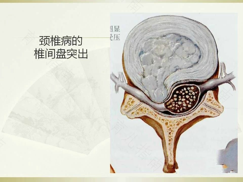 脊柱裂影像学表现 脊柱裂影像学表现