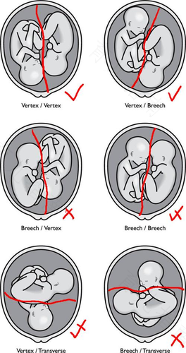 宫内宫外同时怀孕是双胞胎吗 宫内宫外同时怀孕是双胞胎吗