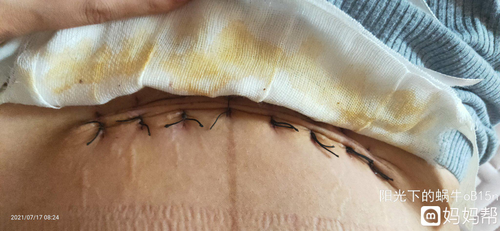 剖腹产有那么吓人吗?