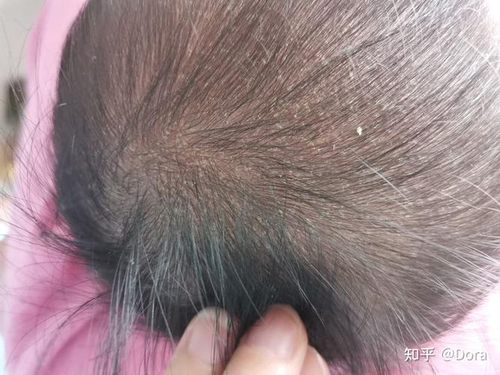 新生儿头上有头垢是什么原因 新生儿头上有头垢是什么原因