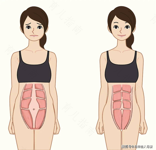 生完孩子腹直肌没有分离 生完孩子腹直肌没有分离