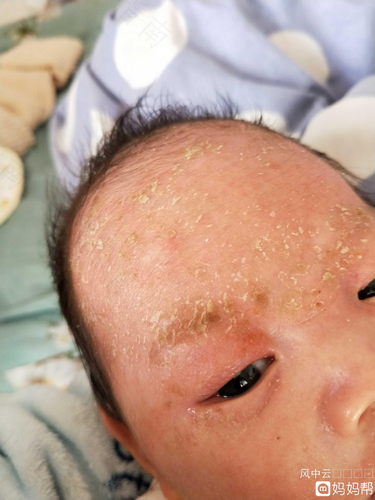 宝宝外耳道湿疹的症状
