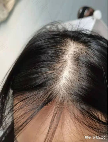 为什么生完孩子后会掉头发 为什么生完孩子后会掉头发