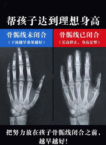 孩子的骨龄偏大怎么办 孩子的骨龄偏大怎么办