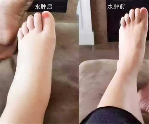 孕妇怀孕水肿怎么办 孕妇怀孕水肿怎么办