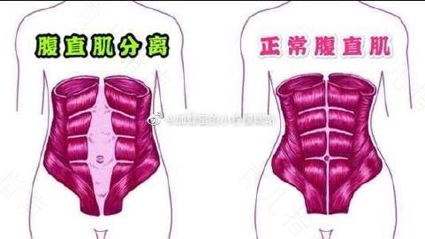 孕前小蛮腰孕后似钱包腹直肌分离怎么办 孕前小蛮腰孕后似钱包腹直肌分离怎么办