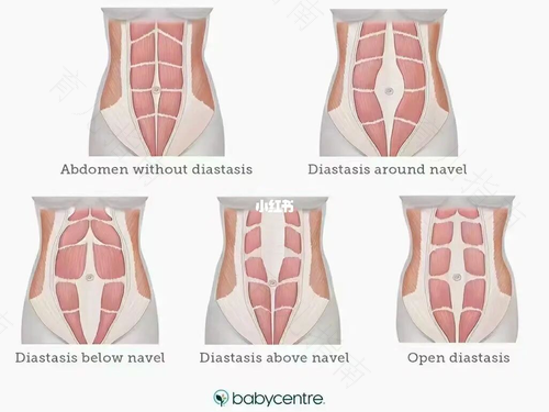 生完孩子都会腹直肌分离吗 生完孩子都会腹直肌分离吗