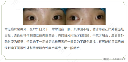 斜视手术后护理
