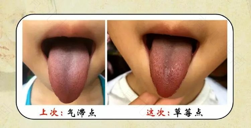 小儿舌诊辨证,如何推拿? 小儿舌诊辨证,如何推拿?