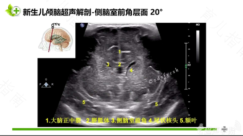 新生儿颅脑超声诊断学 新生儿颅脑超声诊断学